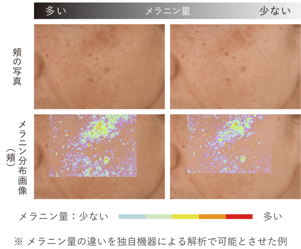 頬の写真 メラニン分布画像(頬) ※メラニン量の違いを独自機器による解析で可能とさせた例